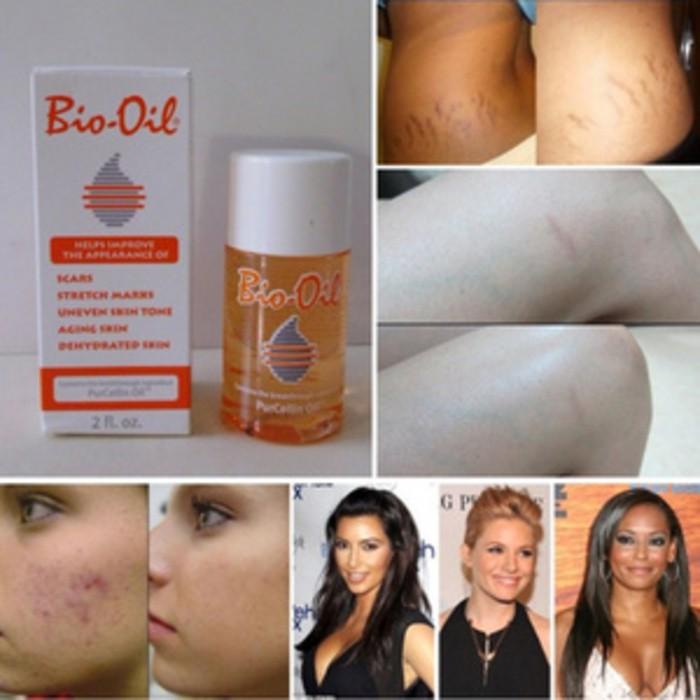 BIO OIL PENGHILANG SCAR DAN SREATCHMARK -