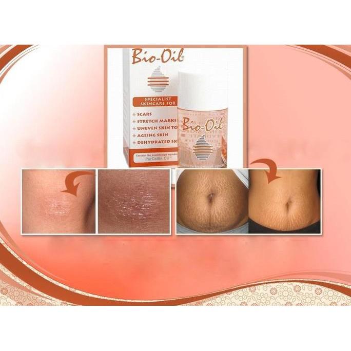 BIO OIL /UNTUK SCAR DAN STREACHMARK - COSME18