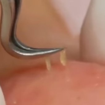 HG Pinset Jepit Komedo / Blackhead Tweezer / Penjepit Komedo Jerawat